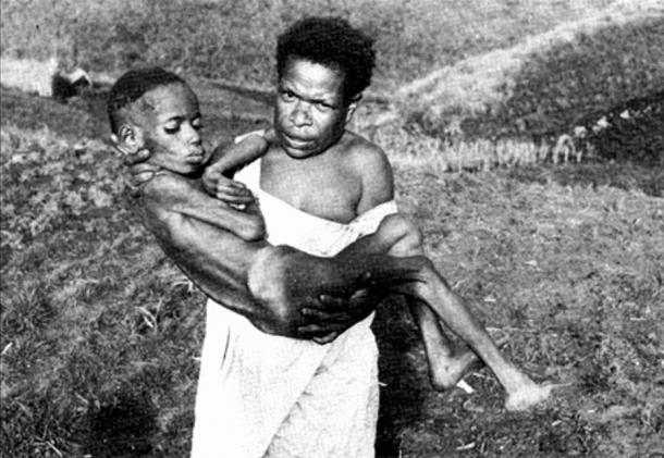 A Fore tribeswoman carrying a child with kuru disease ( Macalester.edu)  Diet of human brains helped Papua New Guinea tribe to resist disease